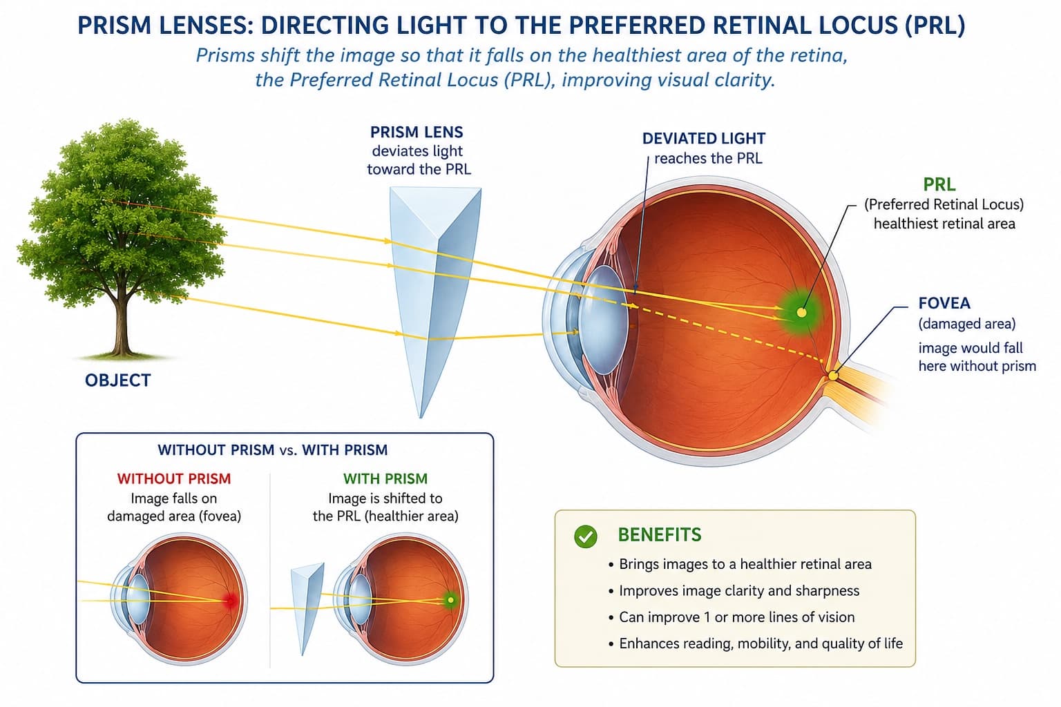 Prism glasses used in vision rehabilitation