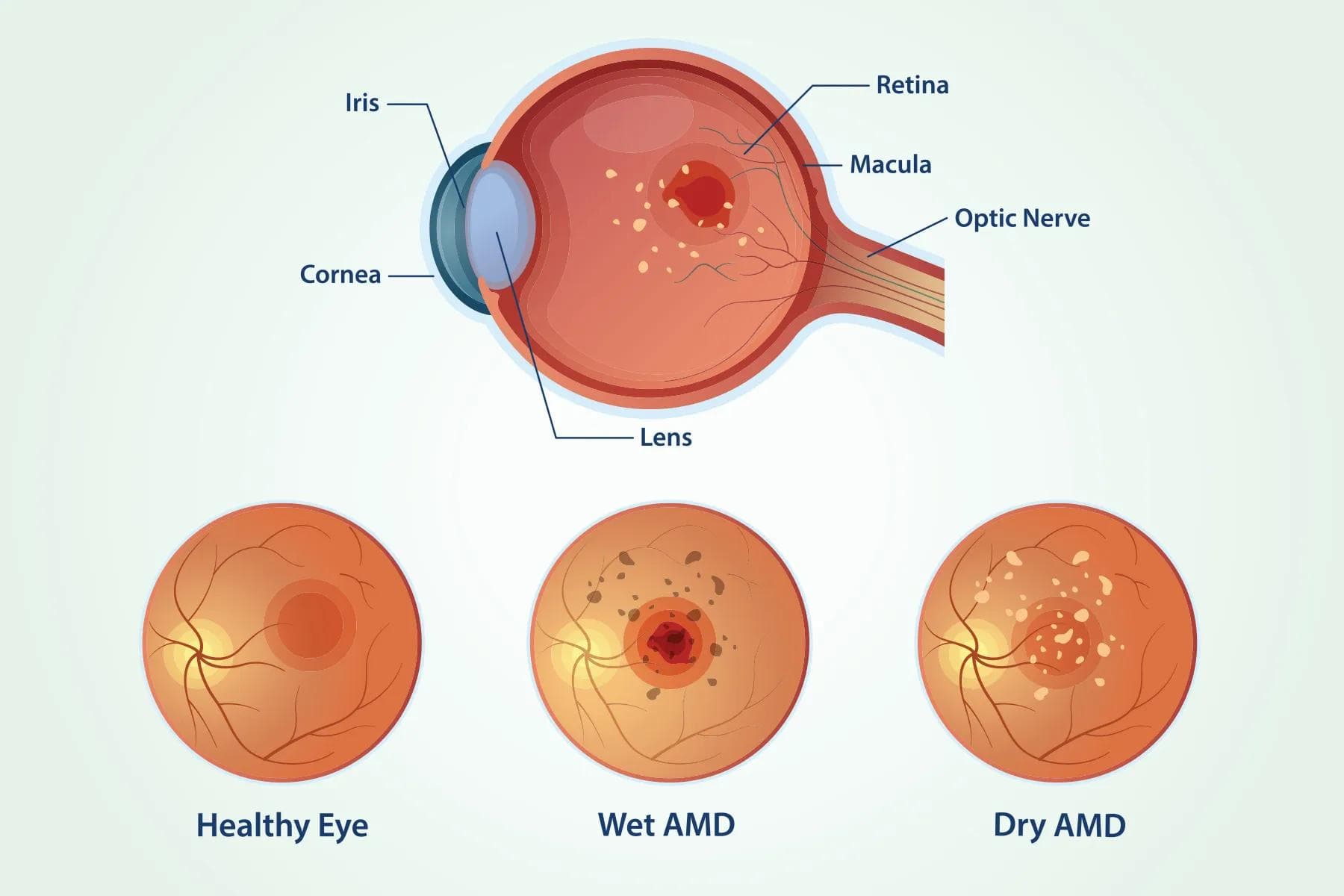 Diagram comparing healthy eye, wet AMD, and dry AMD